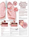 Chronic Obstructive Pulmonary Disease (COPD). 20X26 Laminated Chart.